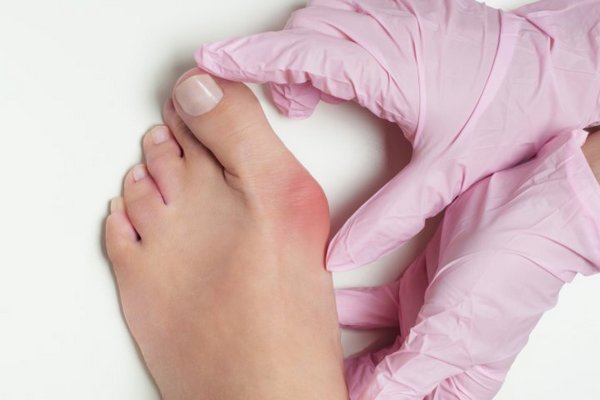 5 способов избавиться от косточки на ноге без помощи хирурга