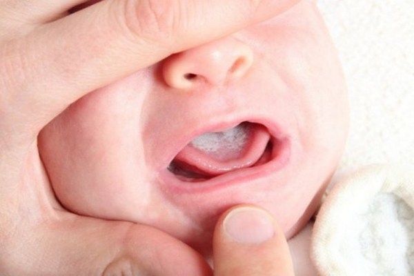 Появление молочницы во рту у новорожденных и его лечение.