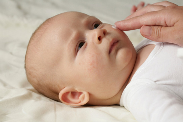 Сыпь на щечках: причины экземы у детей
