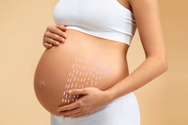 Растяжки при беременности: 5 причин, почему они появляются и как их предотвратить