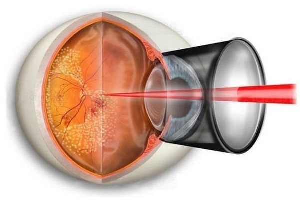 Как проводится диагностика болезней сетчатки глаза
