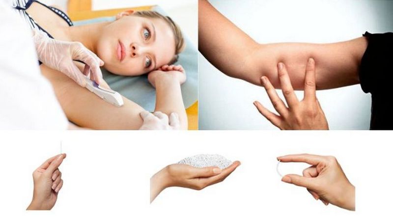 Таблетки, спираль или имплант: как выбрать контрацептив